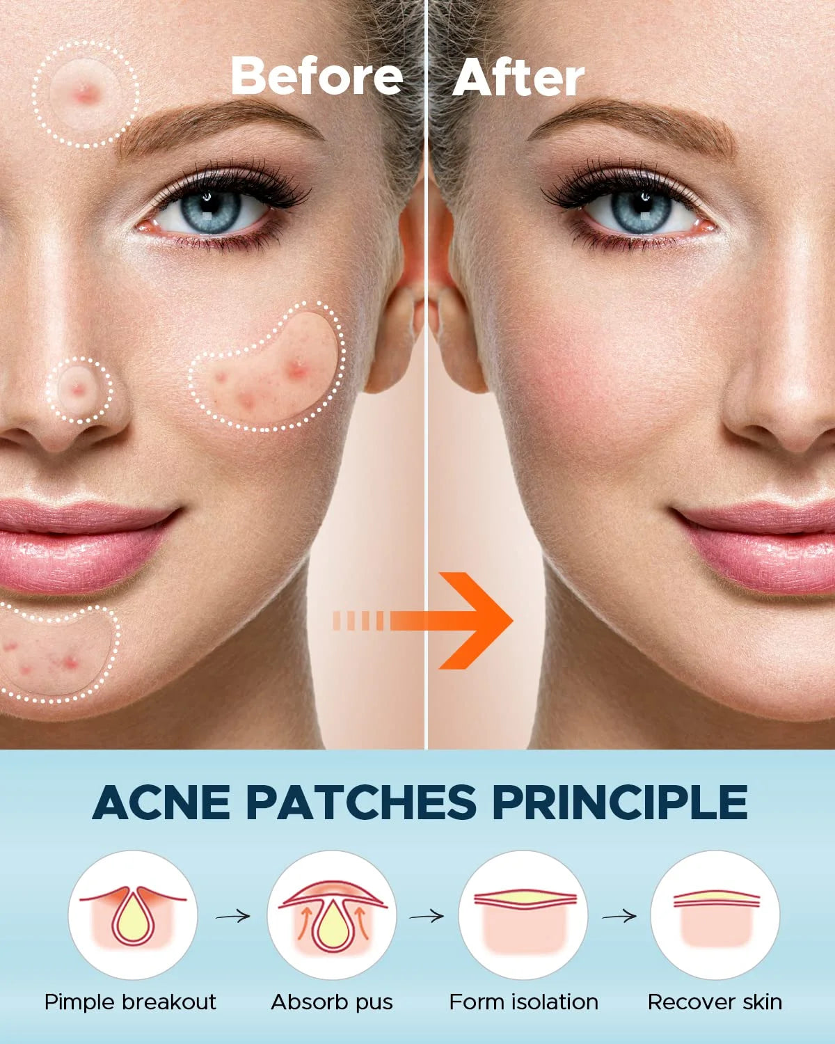 Pimple Patches Set, Hydrocolloid Patches for Covering Zits and Blemishes, Pimples Nose Stick Oval Chin Stick, Spot Stickers for Face and Skin