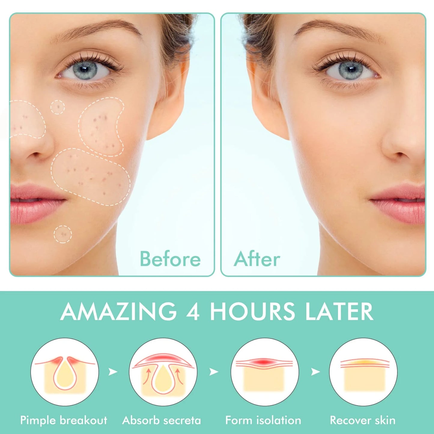 Pimple Patches Set, Hydrocolloid Patches for Covering Zits and Blemishes, Pimples Nose Stick Oval Chin Stick, Spot Stickers for Face and Skin