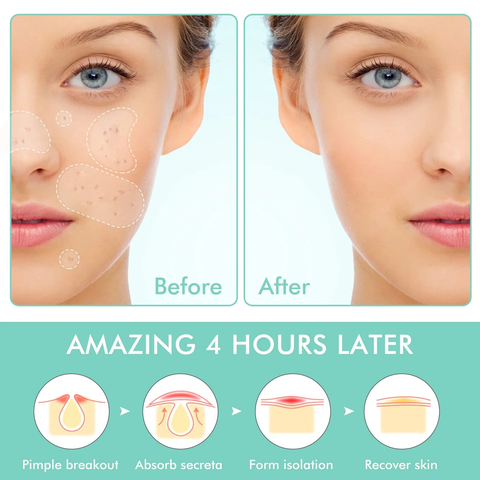 Pimple Patches Set, Hydrocolloid Patches for Covering Zits and Blemishes, Pimples Nose Stick Oval Chin Stick, Spot Stickers for Face and Skin